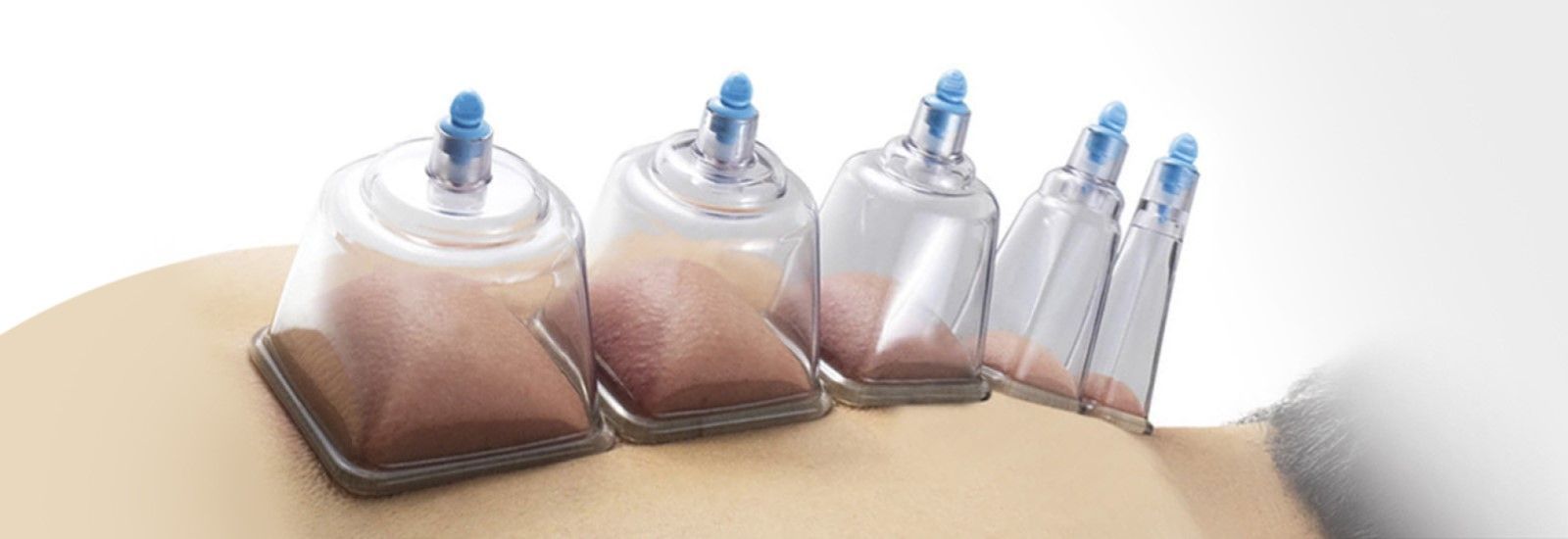 Introduction to Yin-Yang Cupping